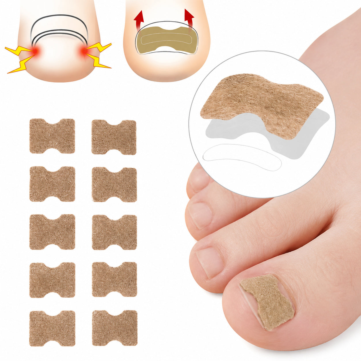 Nageltrångstejp applicerad på stortån för att hjälpa till att lyfta nagelkanterna, minska tryck och lindra obehag vid nageltrång.