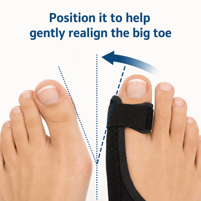 Infografik som visar hur en hallux valgus-nattskena hjälper till att rikta stortån mot en mer naturlig position för ökat stöd och avlastning.