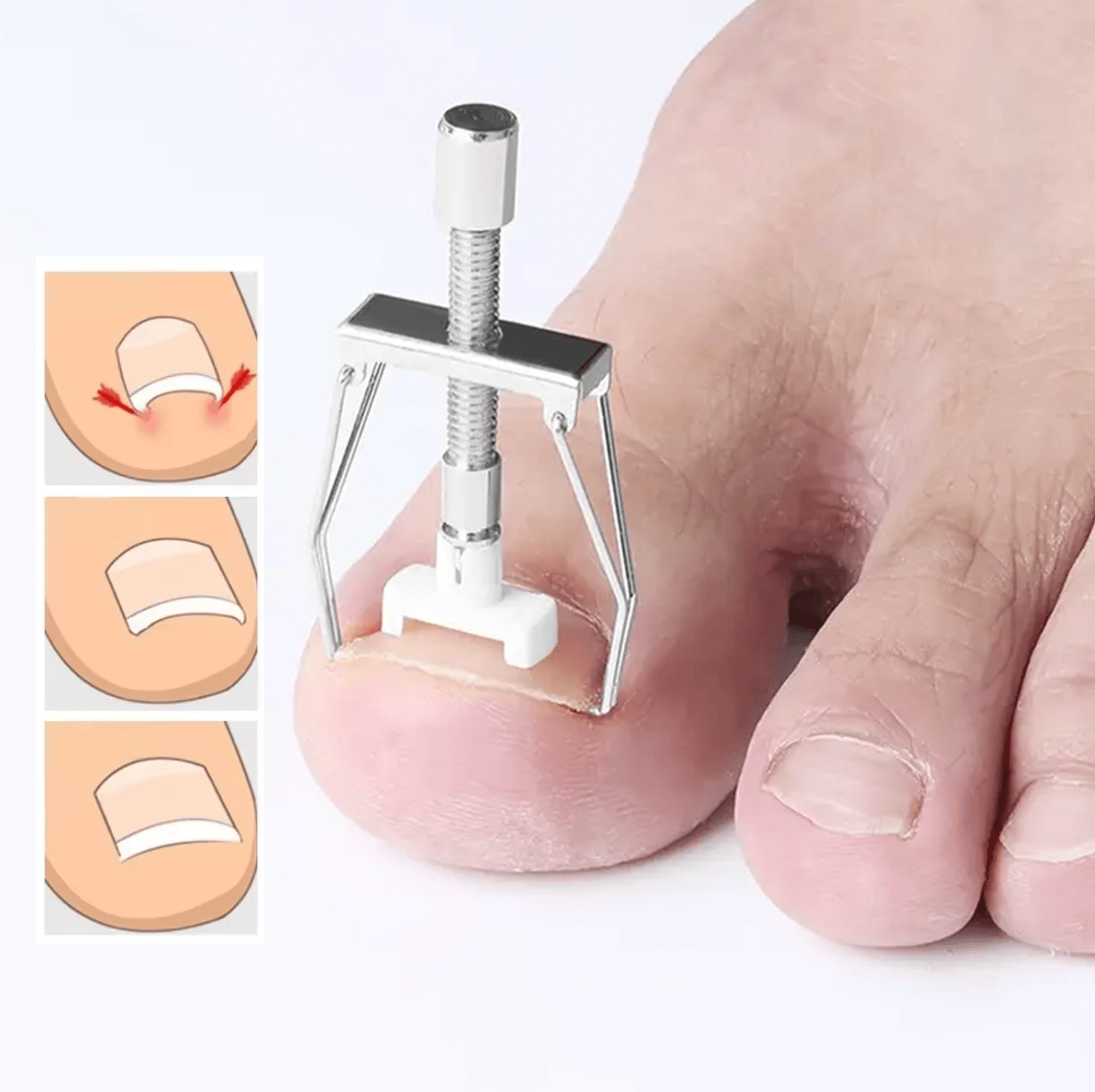 Verktyg för att korrigera nageltrång placerat på stortån.